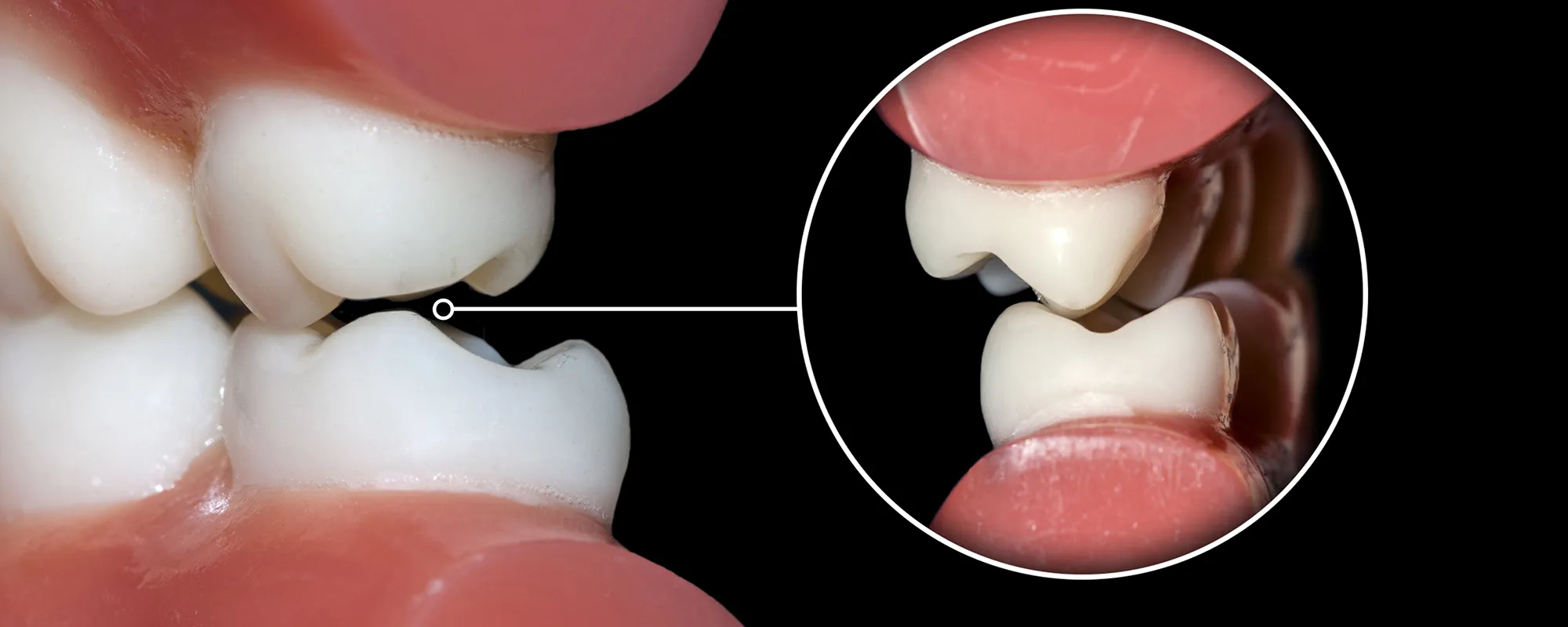 噛み合わせによる主な症状・治療法｜シティデンタルクリニック そよらリーフシティ市川