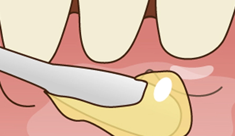 表面麻酔｜シティデンタルクリニック そよらリーフシティ市川