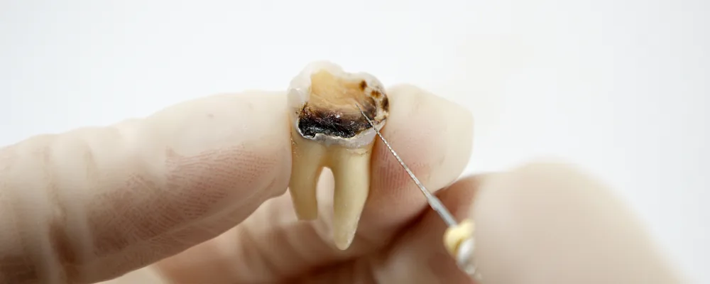 虫歯が進行して抜いた歯の断面と歯科用の器具｜シティデンタルクリニック そよらリーフシティ市川