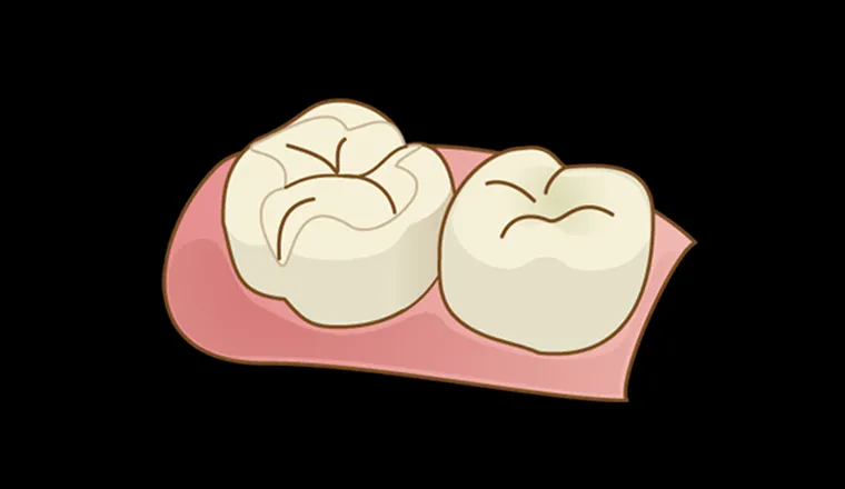 オールセラミックインレー｜シティデンタルクリニック そよらリーフシティ市川