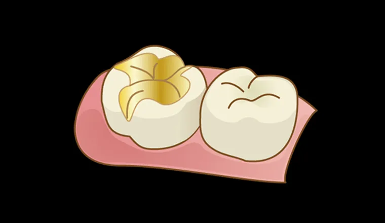 ゴールドインレー｜シティデンタルクリニック そよらリーフシティ市川