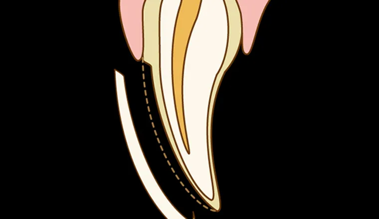 ラミネートベニア｜シティデンタルクリニック そよらリーフシティ市川