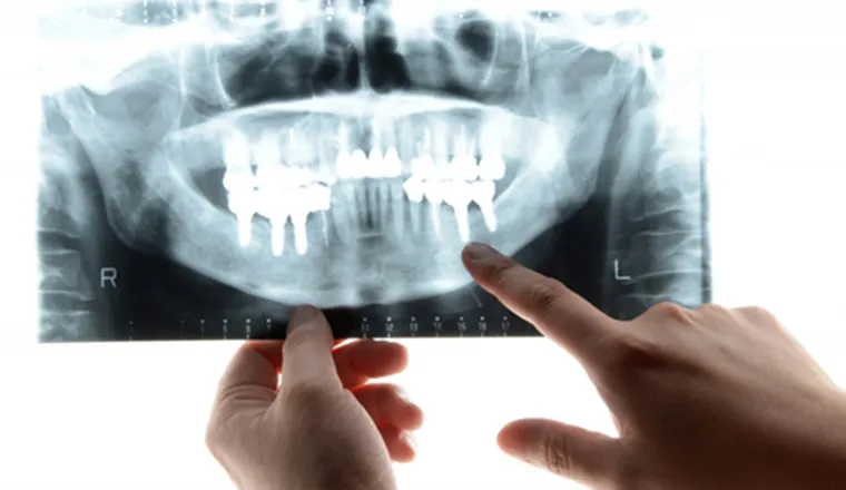 ガイドシステムによる緻密なインプラント治療｜シティデンタルクリニック そよらリーフシティ市川