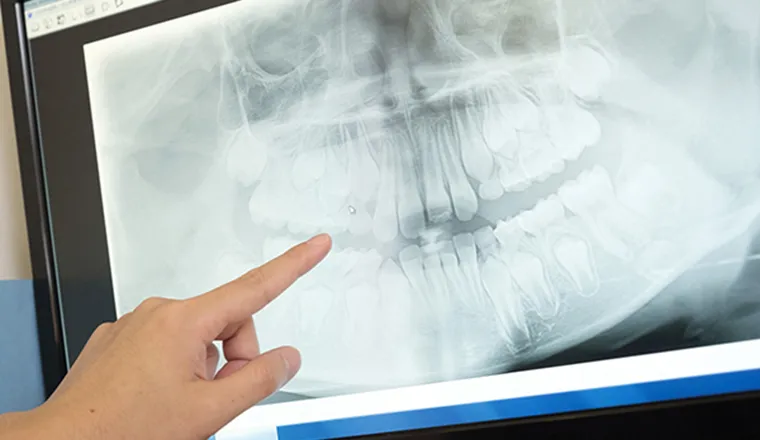 「骨の再生治療・骨造成」にも対応しています｜シティデンタルクリニック そよらリーフシティ市川