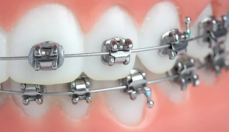 ワイヤー矯正（マルチブラケット）｜シティデンタルクリニック そよらリーフシティ市川