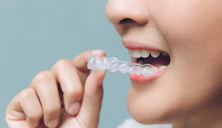 マウスピース型カスタムメイド矯正｜シティデンタルクリニック そよらリーフシティ市川