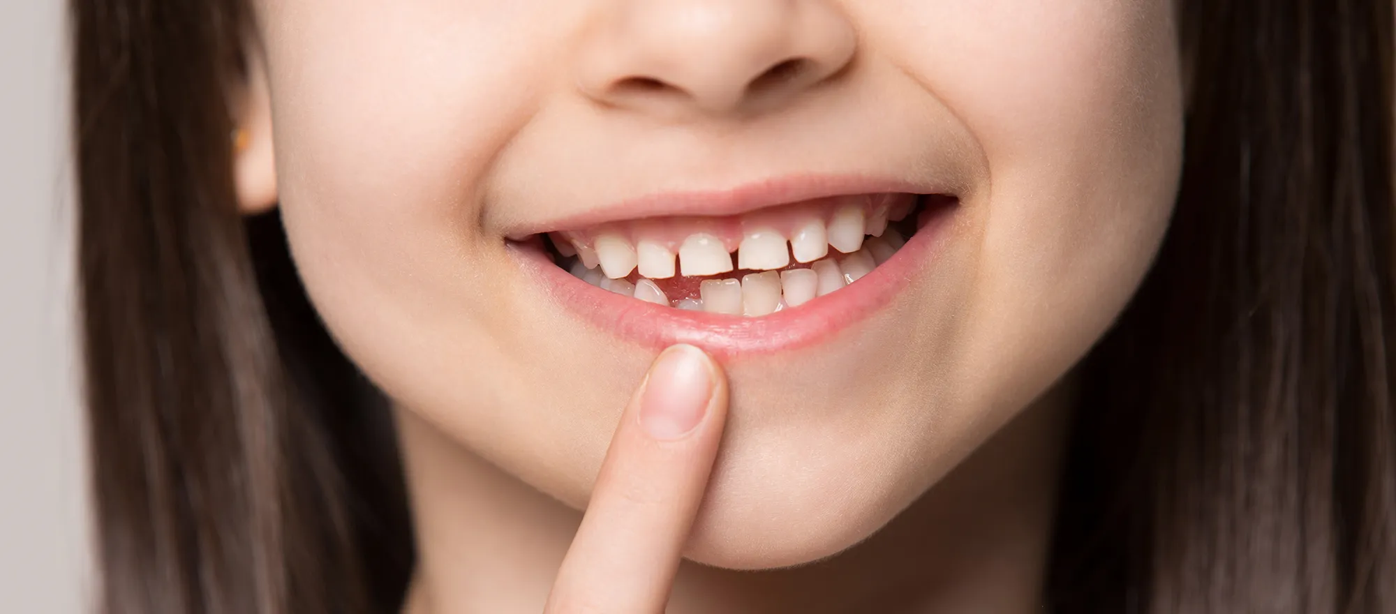 当院の小児矯正（子どもの矯正治療）｜シティデンタルクリニック そよらリーフシティ市川