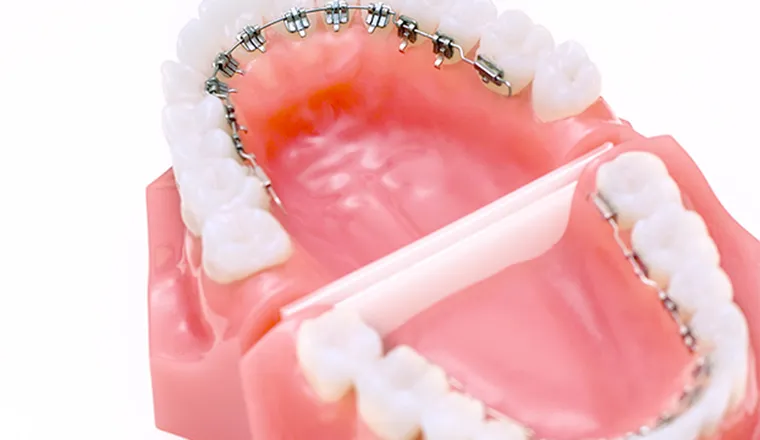 ワイヤー矯正（マルチブラケット）｜シティデンタルクリニック そよらリーフシティ市川