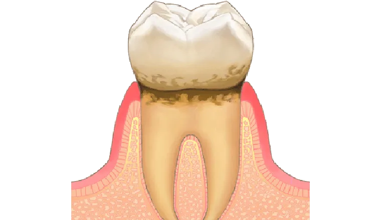 歯肉炎｜シティデンタルクリニック そよらリーフシティ市川