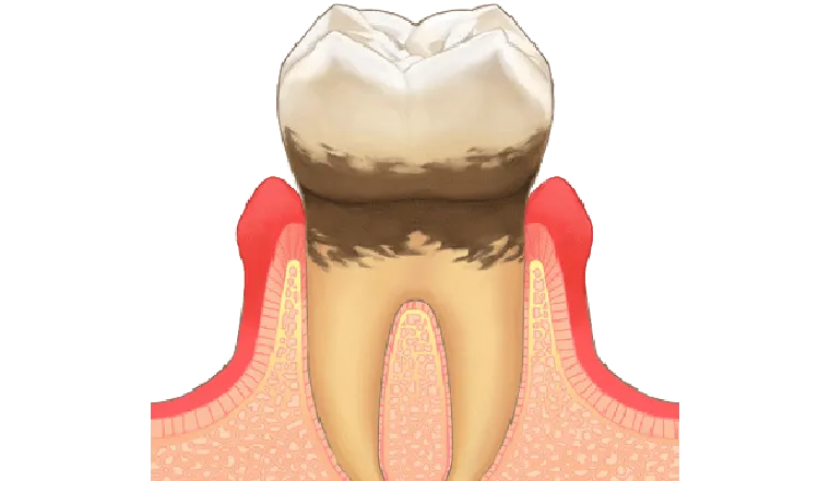 歯周病の初期｜シティデンタルクリニック そよらリーフシティ市川