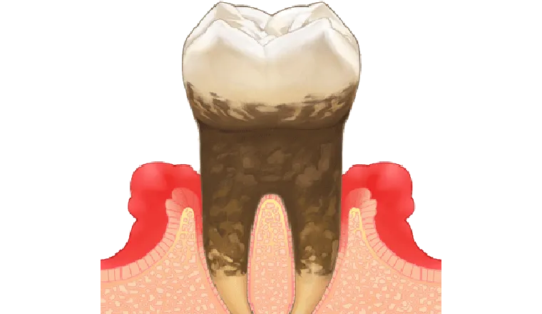 歯周病の中期｜シティデンタルクリニック そよらリーフシティ市川