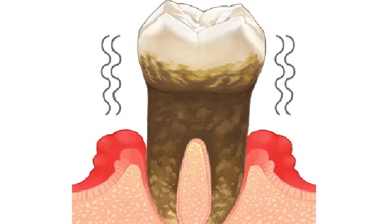 歯周病の重度期｜シティデンタルクリニック そよらリーフシティ市川