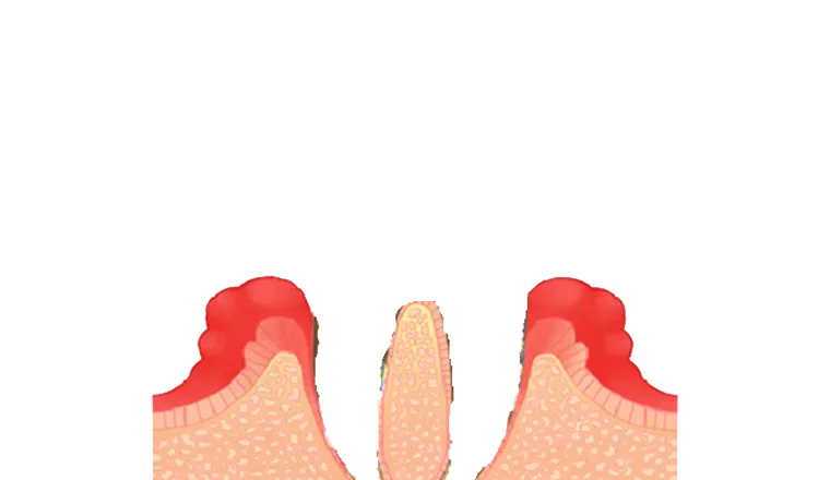 歯周病の末期｜シティデンタルクリニック そよらリーフシティ市川