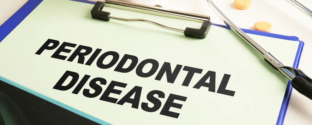 PERIODONTAL DISEASEと書かれた検査記録用のクリップボード｜シティデンタルクリニック そよらリーフシティ市川