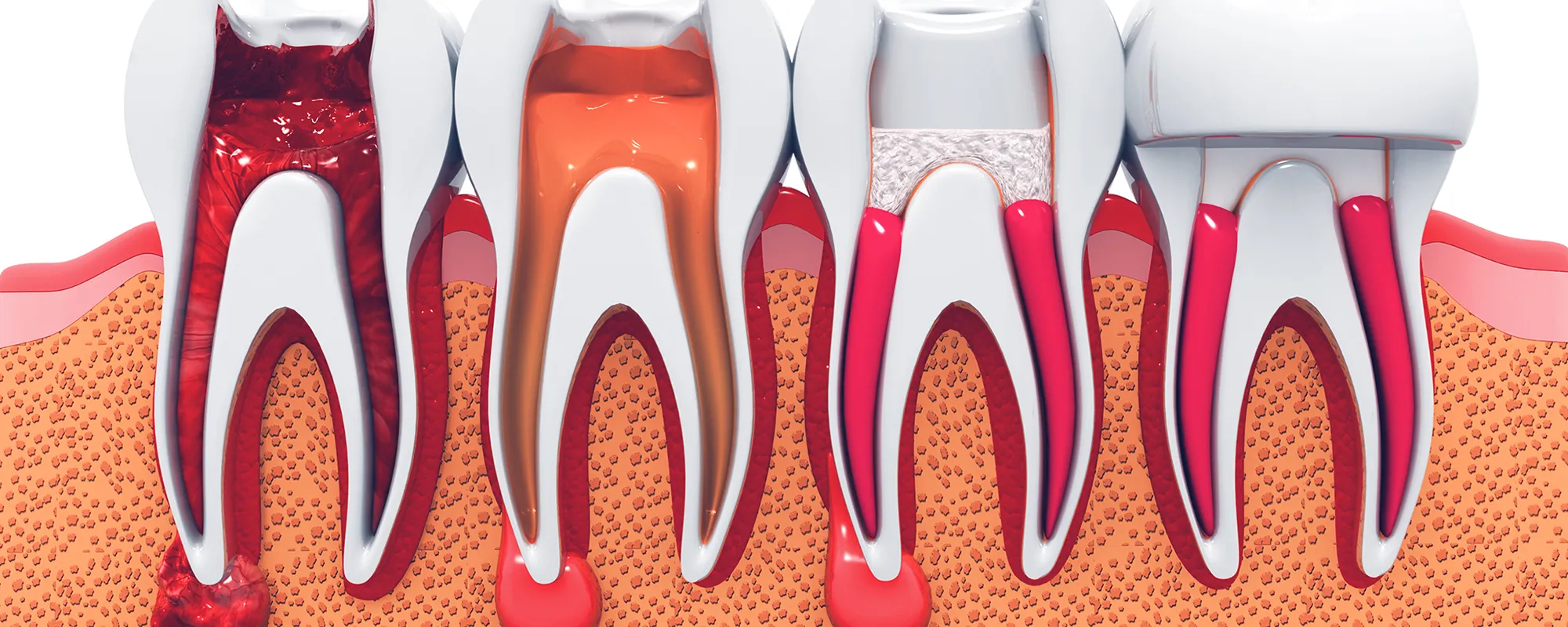 根管治療について｜シティデンタルクリニック そよらリーフシティ市川