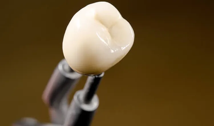 土台と被せ物｜シティデンタルクリニック そよらリーフシティ市川