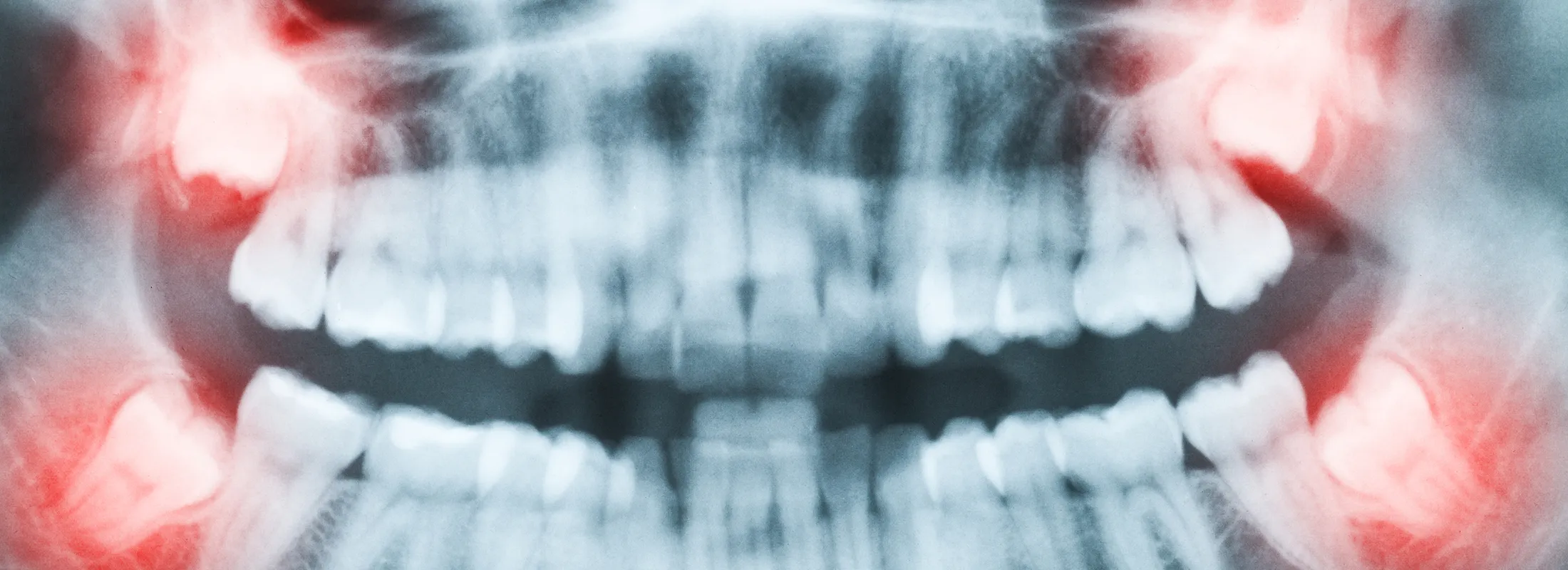 親知らずについて｜シティデンタルクリニック そよらリーフシティ市川